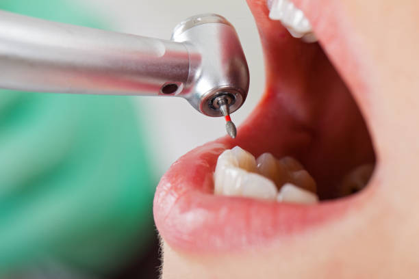Best Emergency Wisdom Teeth Removal in Live Oak, CA